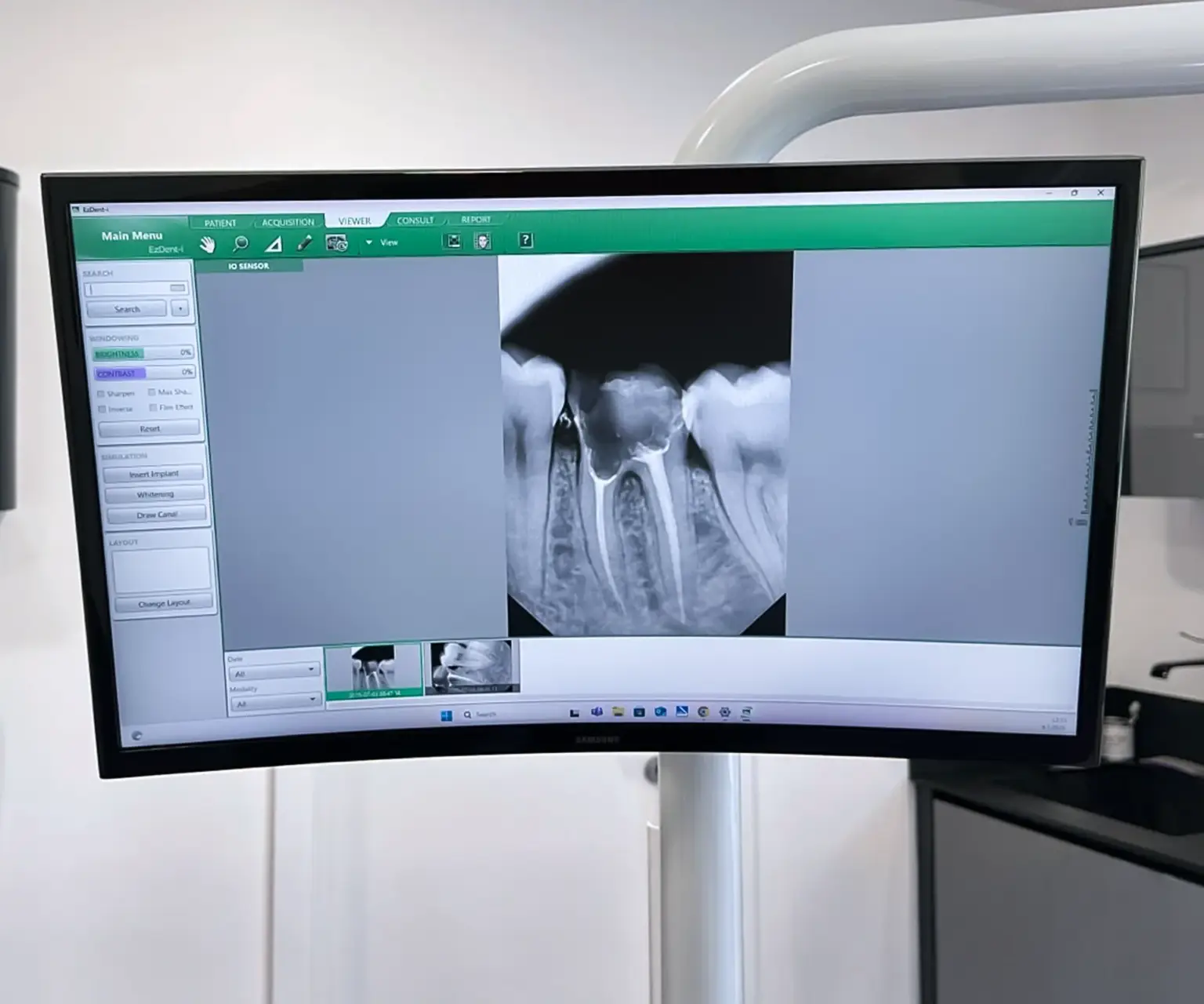 Intraoralna snimka jednog zuba i korjena