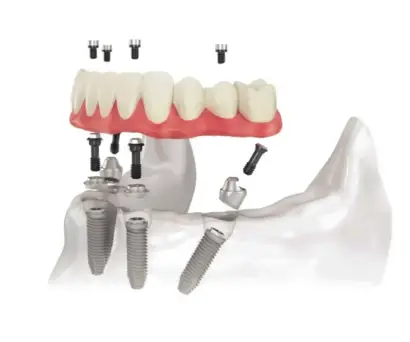 Zubni mostovi primjer