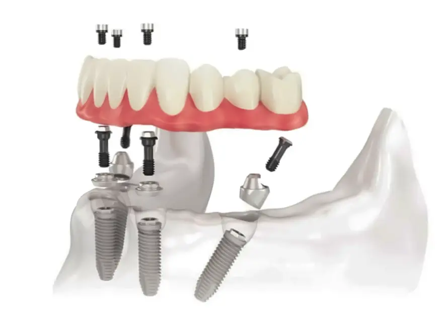 Zubni mostovi primjer