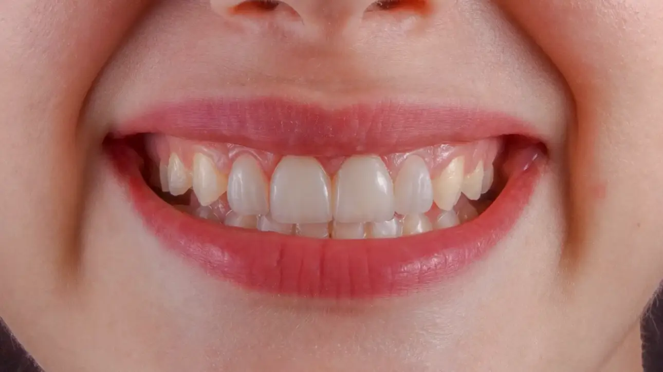 Izbjeljivanje zubi primjer