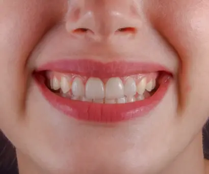 Izbjeljivanje zubi primjer