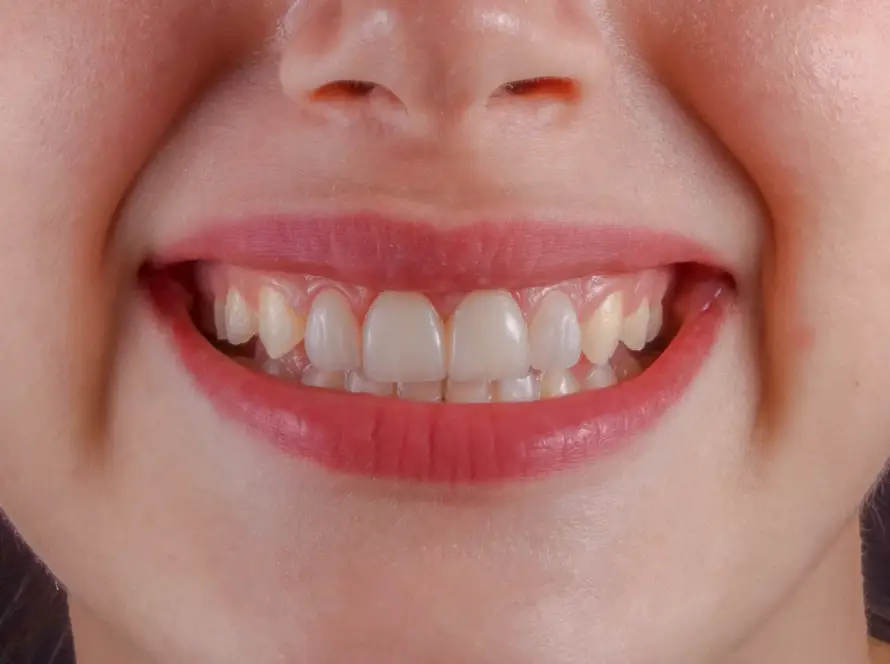 Izbjeljivanje zubi primjer