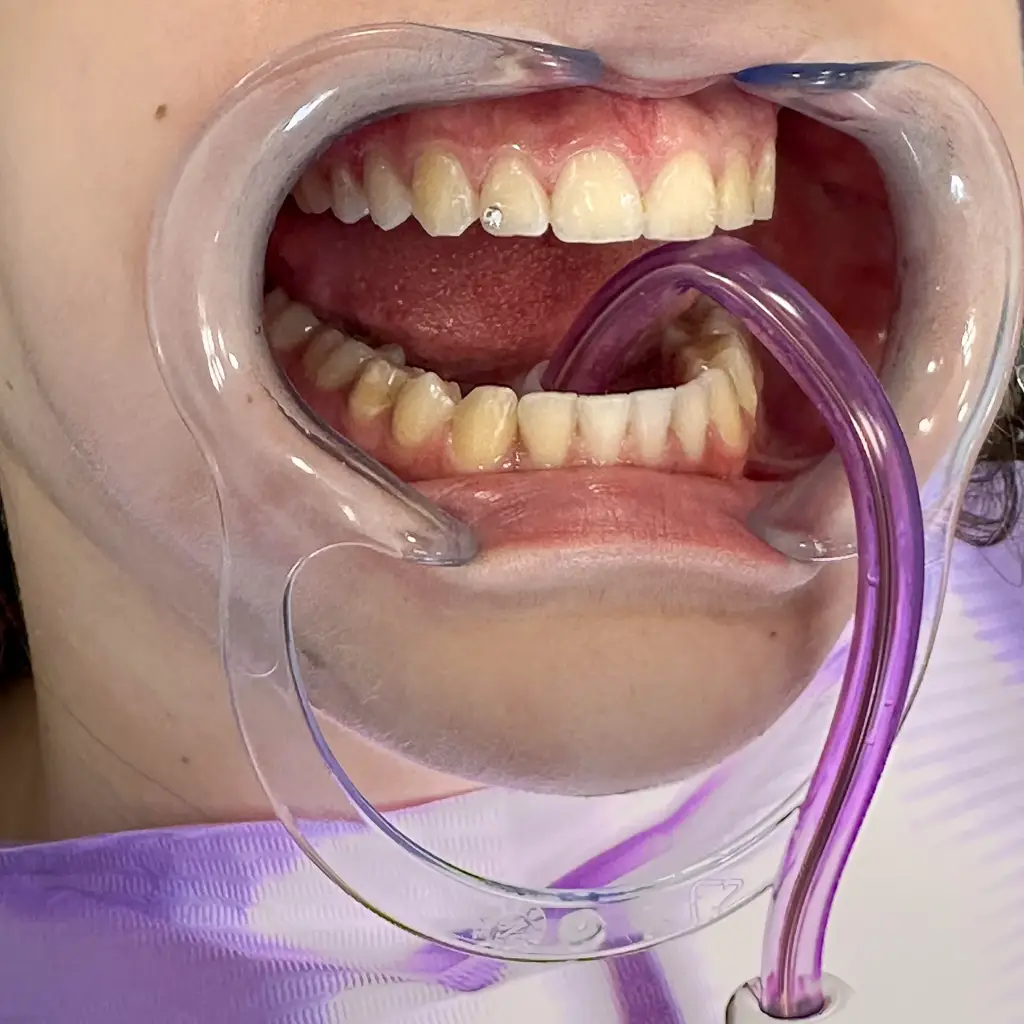 Zubni nakit postupak ugradnje nakita i ukrasa.