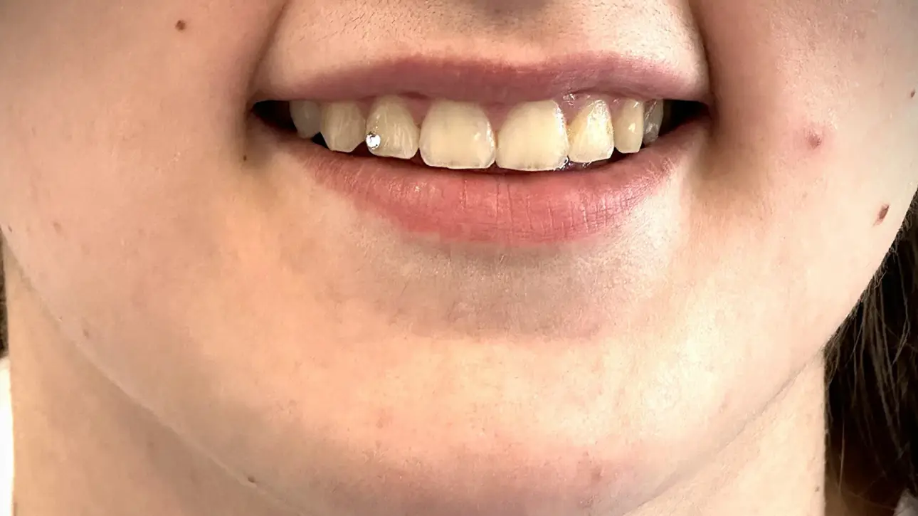 Zubni nakit i ukras za zube na gornjim sjekutićima pacijentice - sjajni detalji za ukrašavanje osmijeha.