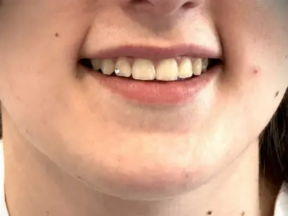 Zubni nakit i ukras za zube na gornjim sjekutićima pacijentice - sjajni detalji za ukrašavanje osmijeha.