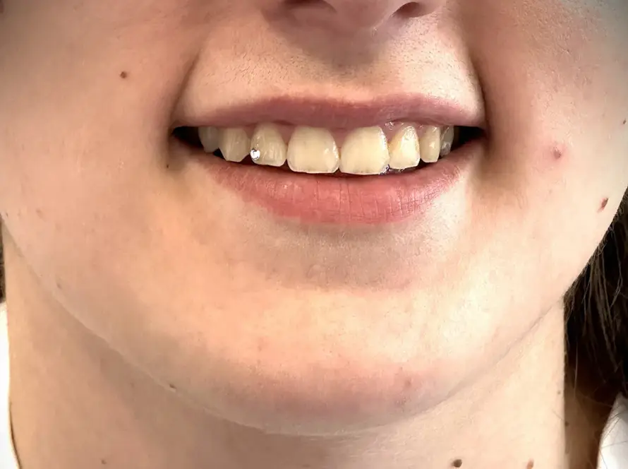 Zubni nakit i ukras za zube na gornjim sjekutićima pacijentice - sjajni detalji za ukrašavanje osmijeha.